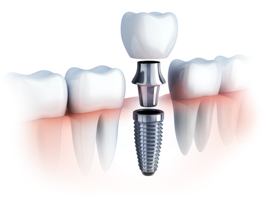 Impianti dentali - Clinica dental