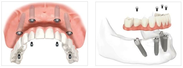 Sopradentadura su 4 impianti dentali