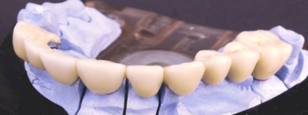 Qual è la differenza tra ponti e corone dentali