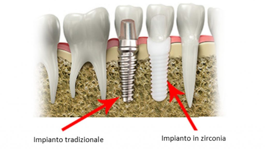 Corona in zirconio, la soluzione metal free