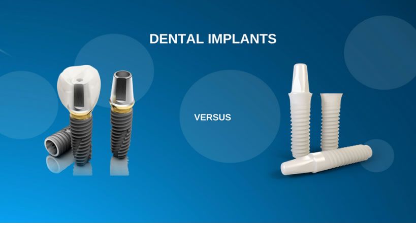 Impianti in ceramica vs impianti in titanio