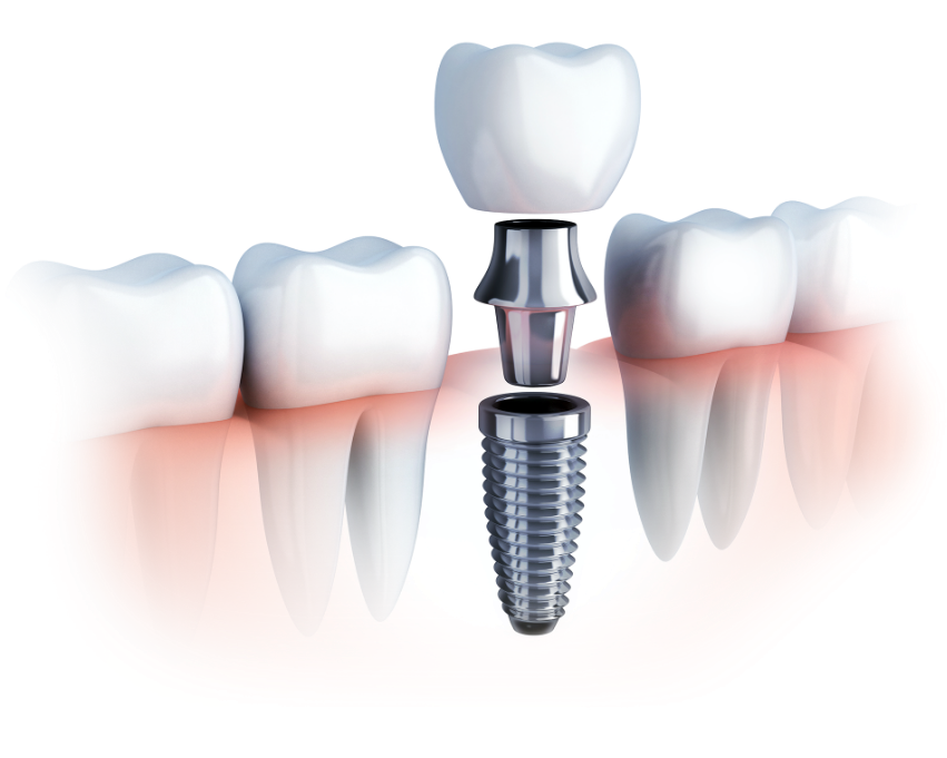 Impianti dentali - Clinica dental: Esperti a Budapest – LaPortaDental