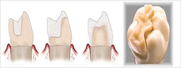 Intarsio dentale: vantaggi, costo e differenze con capsule